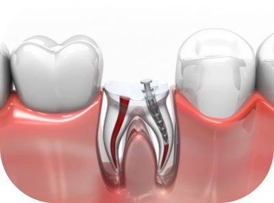 충치, 신경치료