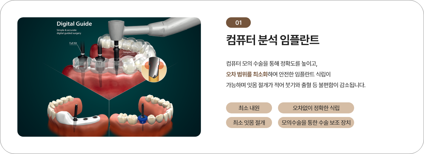 네비게이션(컴퓨터 분석) 임플란트