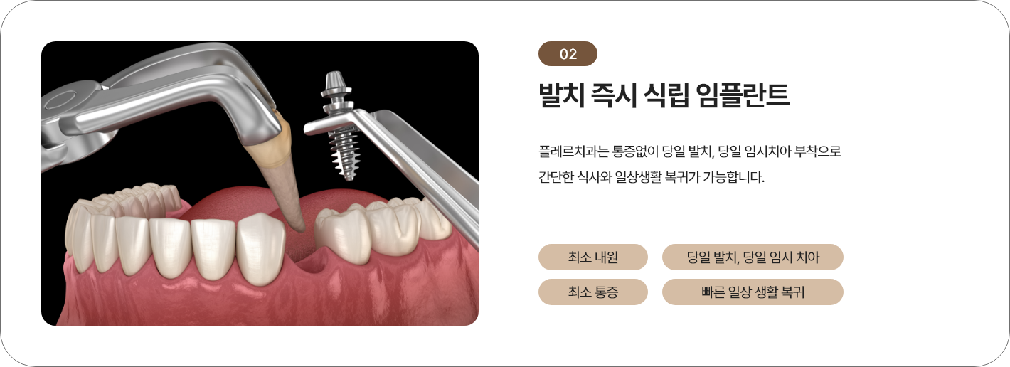 원데이 임플란트