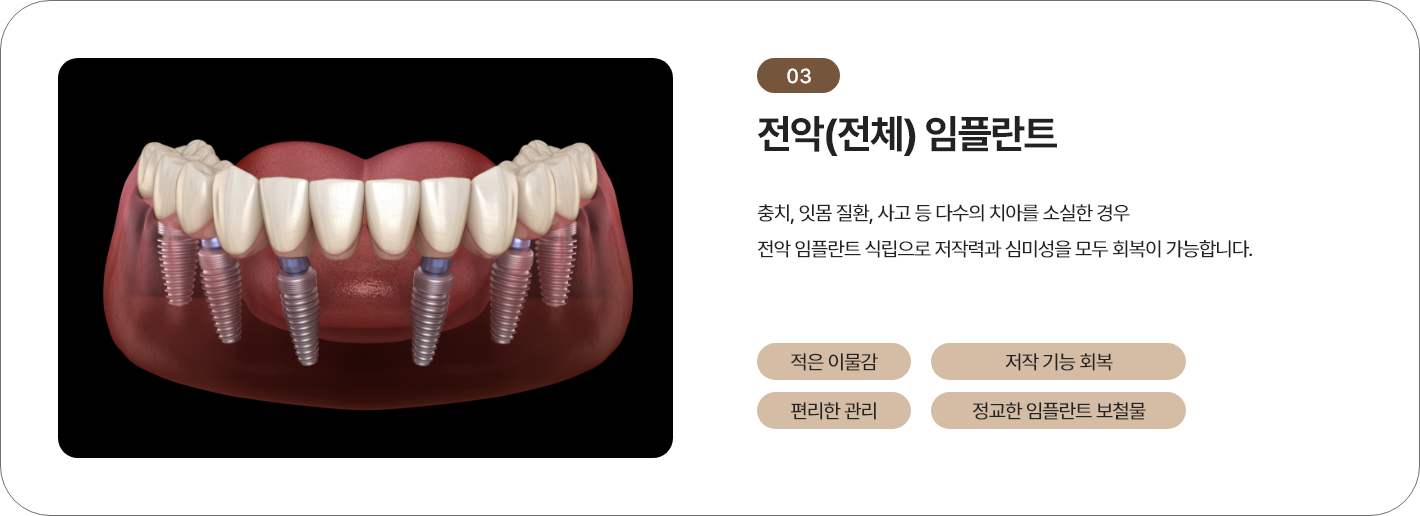 전악(전체) 임플란트