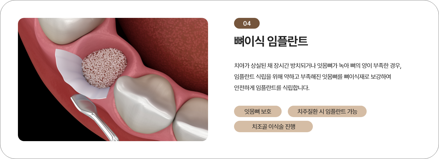 뼈이식 임플란트