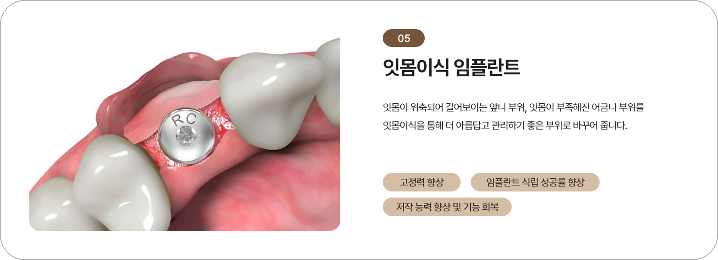 잇몸이식 임플란트